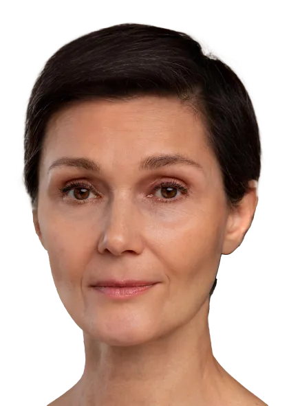 La blefaroplastia con la Dra Pamela es un procedimiento mínimamente invasivo con grandes cambios